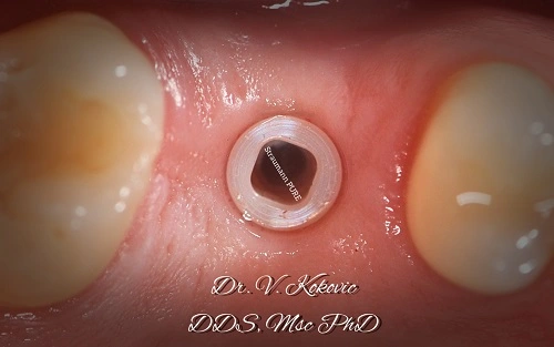 Ceramic Dental Implants